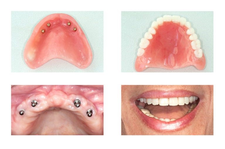 Mini Implants For Dentures Old Bethpage NY 11804